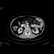 Sclerosing mesenteritis: CT - Computed tomography