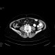 Sclerosing mesenteritis: CT - Computed tomography