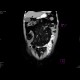 Sclerosing mesenteritis: CT - Computed tomography