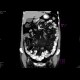 Sclerosing mesenteritis: CT - Computed tomography