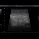 Sclerosing mesenteritis: US - Ultrasound