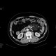 Sclerosing mesenteritis: CT - Computed tomography