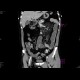 Sclerosing mesenteritis: CT - Computed tomography