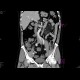 Sclerosing mesenteritis: CT - Computed tomography