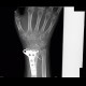 Spotty porosis, fracture of distal radius: X-ray - Plain radiograph