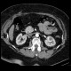Renal cell carcinoma, small: CT - Computed tomography