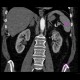 Renal cell carcinoma, small: CT - Computed tomography