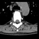 Calcifications in soft tissue in a dialysed patient: CT - Computed tomography