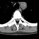 Calcifications in soft tissue in a dialysed patient: CT - Computed tomography