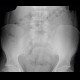 Spina bifida, sacral vertebra: X-ray - Plain radiograph