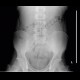 Spina bifida, sacral vertebra: X-ray - Plain radiograph