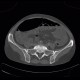Spina bifida, S1: CT - Computed tomography