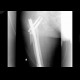 Spiral subtrochanteric fracture: X-ray - Plain radiograph