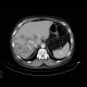 Splenic hemangioma, liver metastases, colon carcinoma: CT - Computed tomography