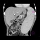 Splenomegally, porcelain gall bladder: CT - Computed tomography