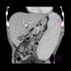 _fetch_thumbnail.php?img=Splenomegally.CT.1_0001.JPG