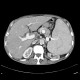 Splenomegally, porcelain gall bladder: CT - Computed tomography