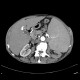 Splenomegally, porcelain gall bladder: CT - Computed tomography