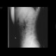 Spondylolisthesis, spondylolysis, spina bifida: X-ray - Plain radiograph