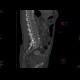 Spondylolysis, spondylolisthesis, lumbar vertebra: CT - Computed tomography