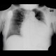 Cardiomegally on chest radiograph: X-ray - Plain radiograph