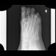 Anomally of the little finger of the foot, congenital: X-ray - Plain radiograph