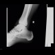 Fracture of processus posterior tali: X-ray - Plain radiograph