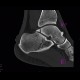 Fracture of processus posterior tali: CT - Computed tomography