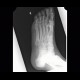 Fracture of metatarsal bone, subacute fracture: X-ray - Plain radiograph