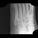 Fracture of metatarsal bone, subacute fracture: X-ray - Plain radiograph