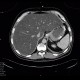 Liver steatosis: CT - Computed tomography