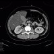 Liver steatosis: CT - Computed tomography