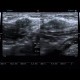 Suture granuloma: US - Ultrasound