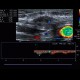 Suture granuloma: US - Ultrasound