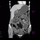 Crohn's disease, stenosis, prestenotic dilatation, CT enterography at 3 years: CT - Computed tomography