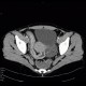 Crohn's disease, terminal ileum, stenosis, CT enterography: CT - Computed tomography