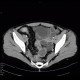 Crohn's disease, terminal ileum, stenosis, CT enterography: CT - Computed tomography