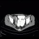 Crohn's disease, terminal ileum, stenosis, CT routine: CT - Computed tomography