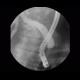 Stenosis of biliary duct, pancreatic carcinoma, ERCP: RF - Fluoroscopy