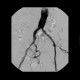 Stenosis of common iliac artery, stent: AG - Angiography