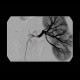 Stenosis of renal artery, stent: AG - Angiography