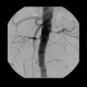 Stenosis of renal artery, stent: AG - Angiography