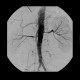 Stenosis of renal artery, stent: AG - Angiography