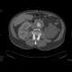 Aneurysm of the abdominal aorta, AAA, aorto-iliac stentgraft: CT - Computed tomography