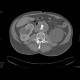 Aneurysm of the abdominal aorta, AAA, aorto-iliac stentgraft: CT - Computed tomography