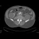 Aneurysm of the abdominal aorta, AAA, aorto-iliac stentgraft: CT - Computed tomography