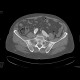 Aneurysm of the abdominal aorta, AAA, aorto-iliac stentgraft: CT - Computed tomography