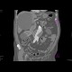 Aneurysm of the abdominal aorta, AAA, aorto-iliac stentgraft: CT - Computed tomography