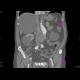 Aneurysm of the abdominal aorta, AAA, aorto-iliac stentgraft: CT - Computed tomography