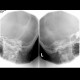 Stenvers view, chronic mastoiditis: X-ray - Plain radiograph